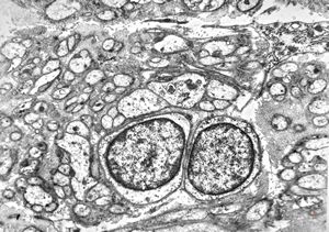 M,58y. | neurofibroma faciei